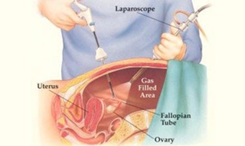 Laparoscopic cancer surgery